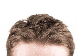 Jak pozbyć się łupieżu szybko i skutecznie